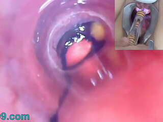 Caméra endoscopique pour endoscope de la vessie d'une femme mûre avec des ballons